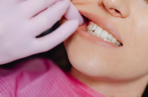 Tooth Contouring and Reshaping